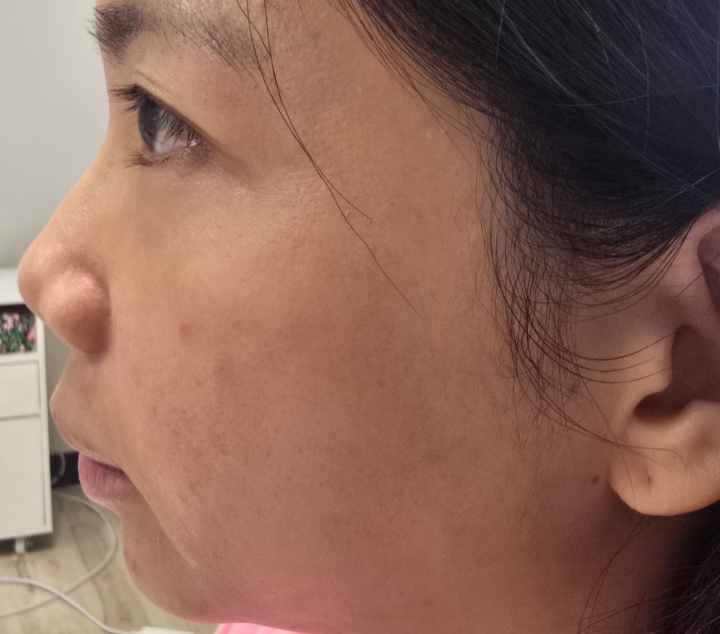 Chin Filler