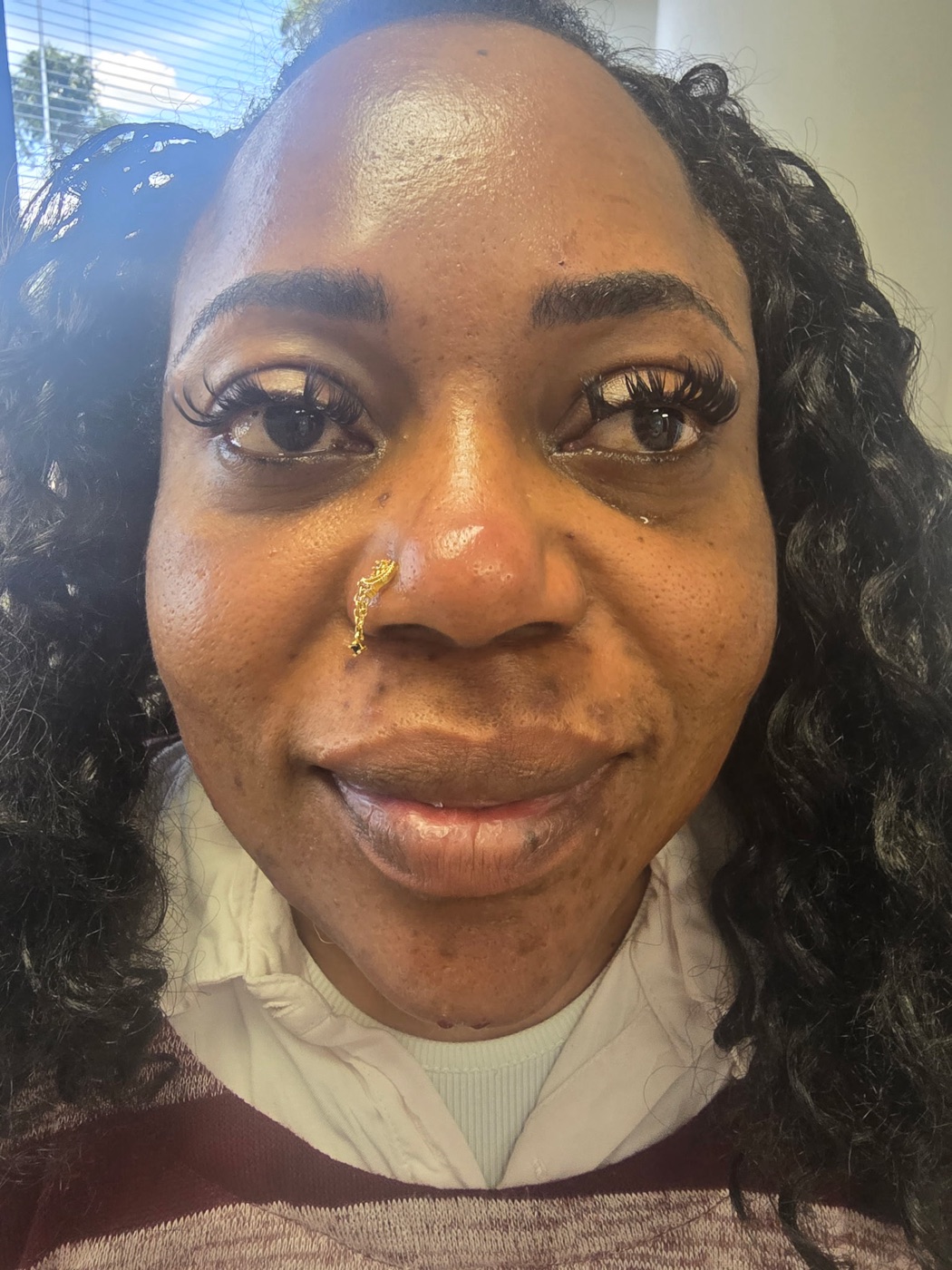 Lower Facial Balancing