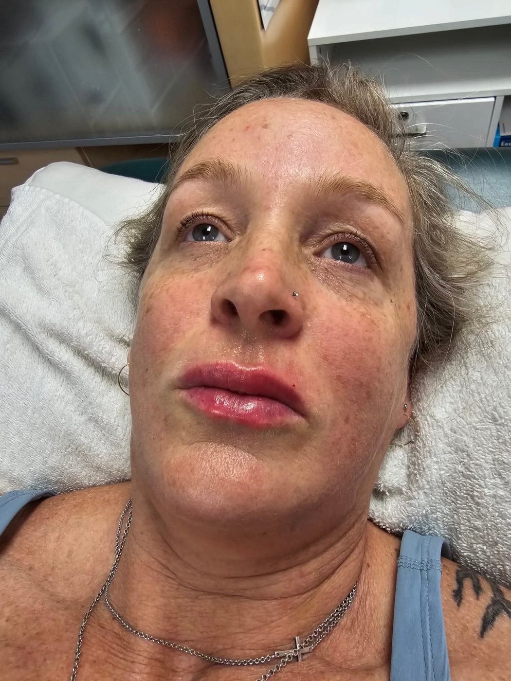 Lip Filler